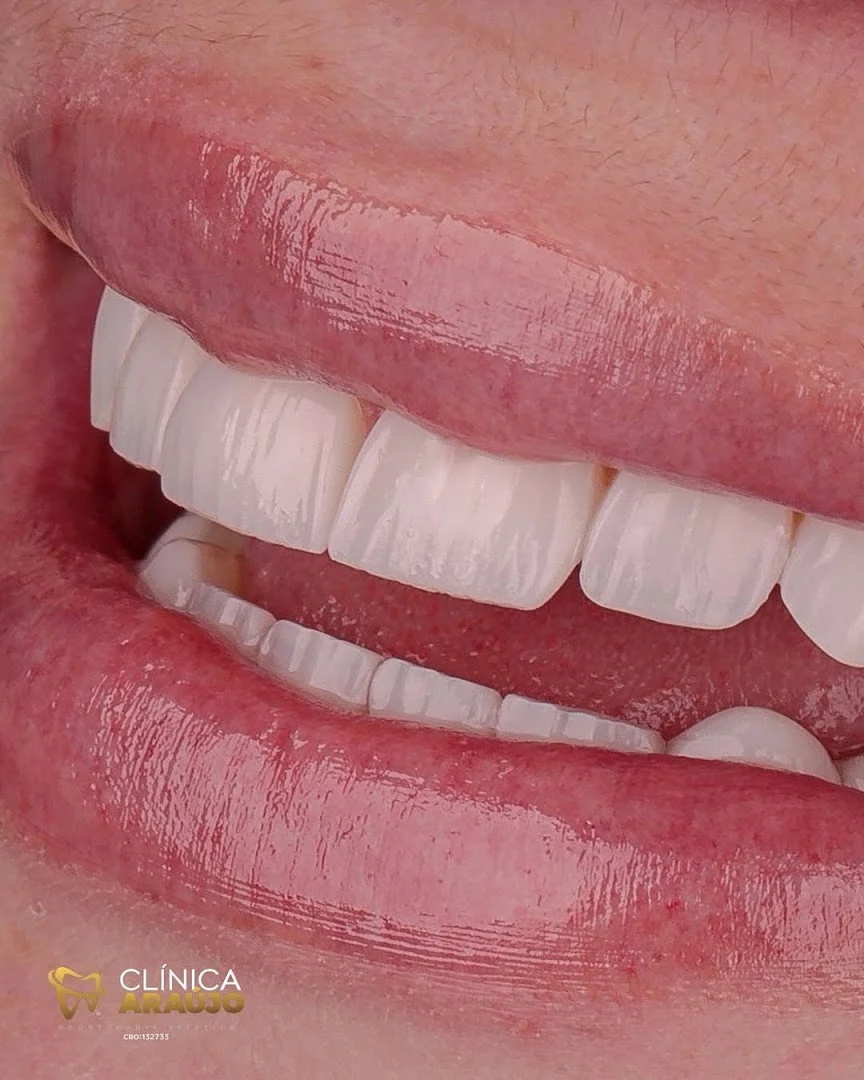 Clinica Felipe Araújo BH - Facetas de Resina em Belo Horizonte - Lentes de Contato Dental - Lentes de Porcelana