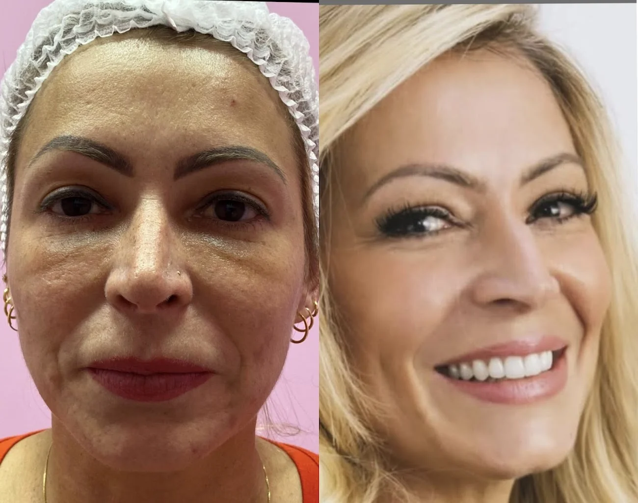 Dra Viviane Dias Faustino/ Especialista em Harmonização facial e corporal / Botox / Rejuvenescimento